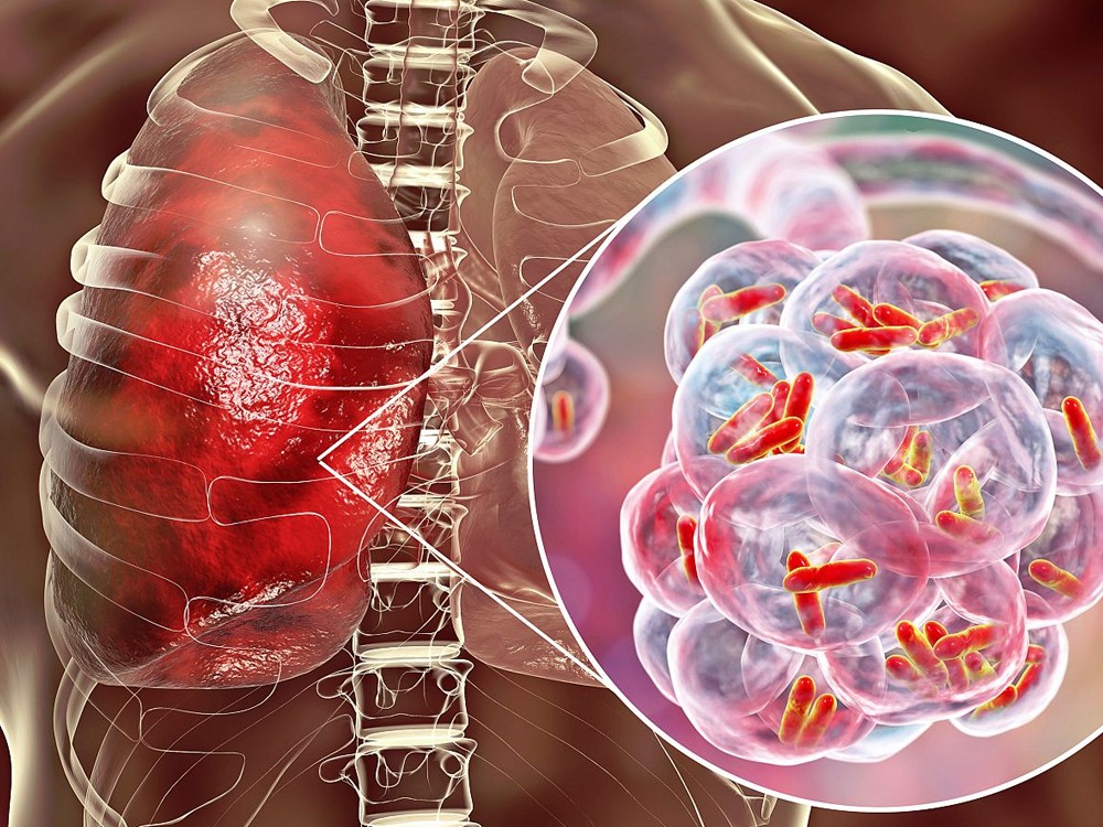 Preparan actividades para conmemorar el día internacional de la tuberculosis 