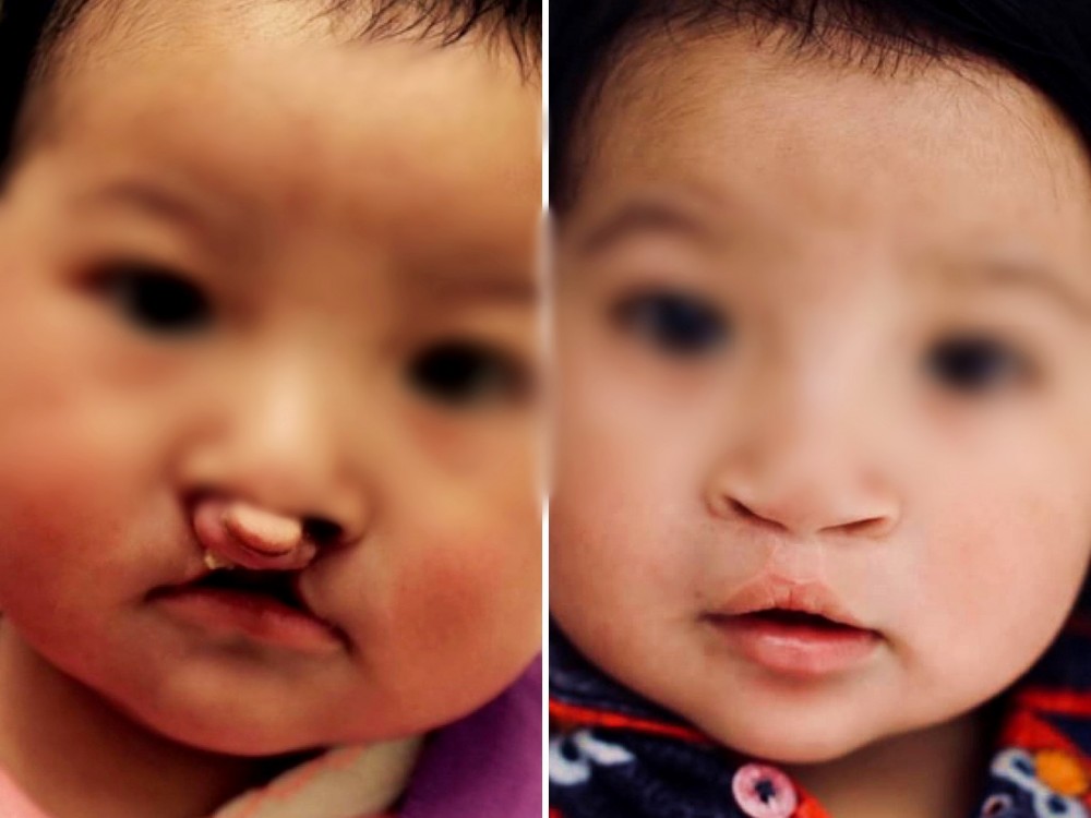 Anuncian jornada para cambiar la sonrisa de niños con labio leporino y paladar hendido