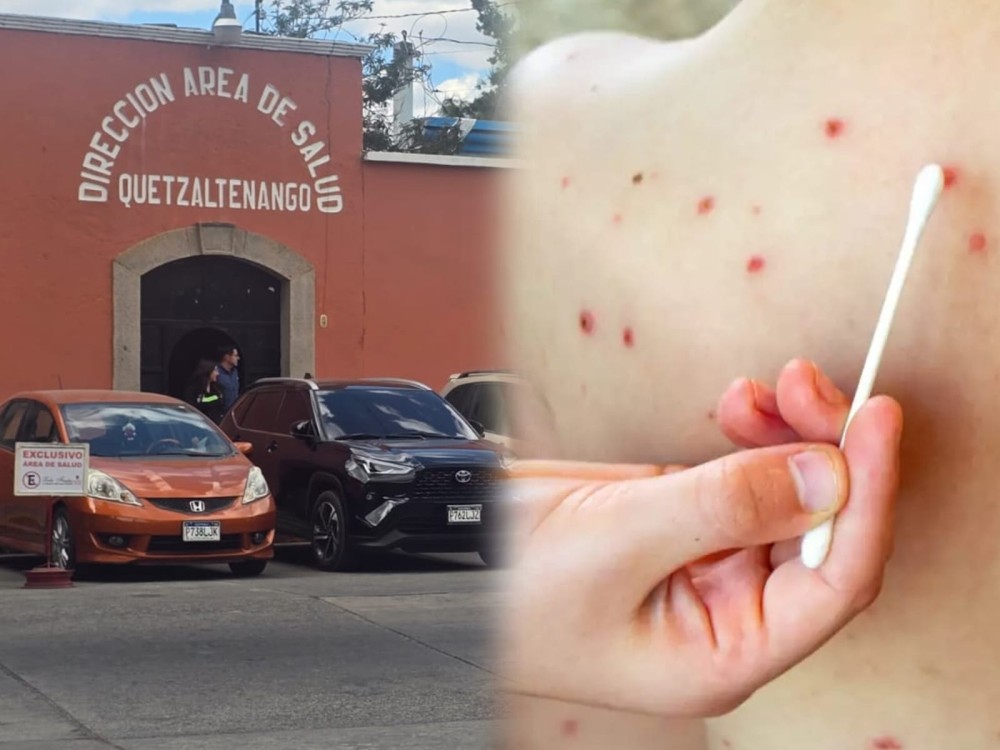 Confirman primer caso de sarampión en Quetzaltenango