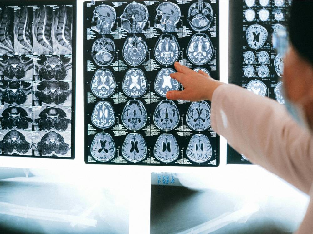 Logran crear mini cerebros humanos para estudiar enfermedades neurológicas