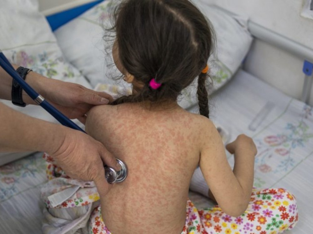 Ministerio de Salud refuerza acciones de vigilancia y control ante casos de sarampión