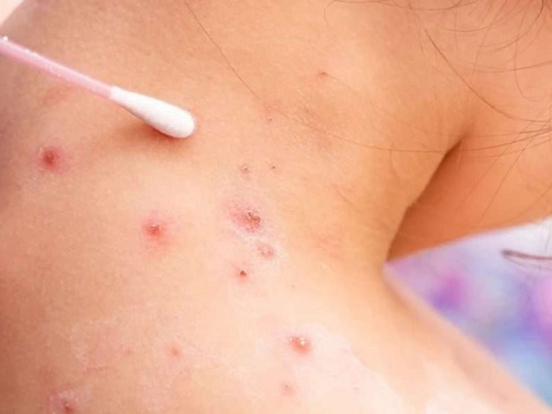 Salud confirma dos nuevos casos de Viruela del Mono en Guatemala